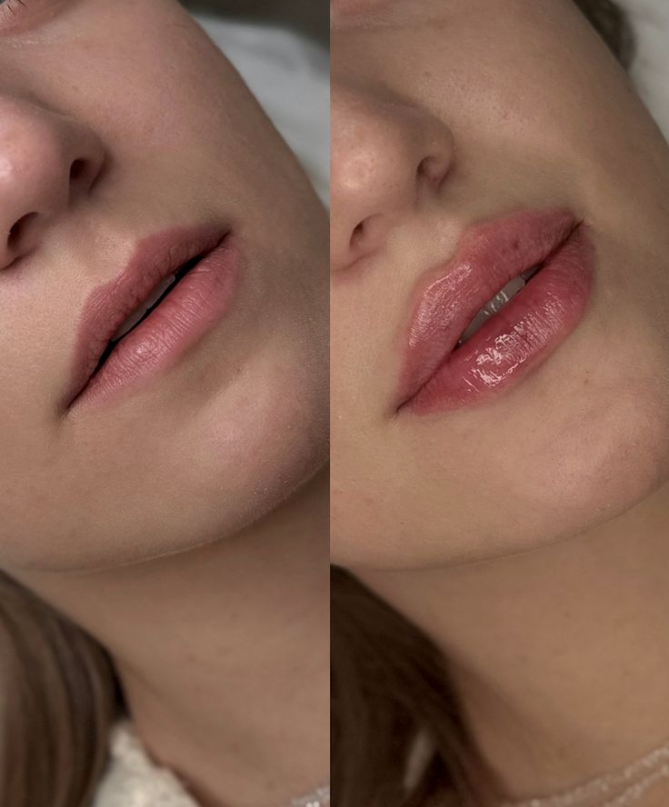 lip fillers in islamabad