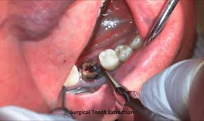 tooth surgery