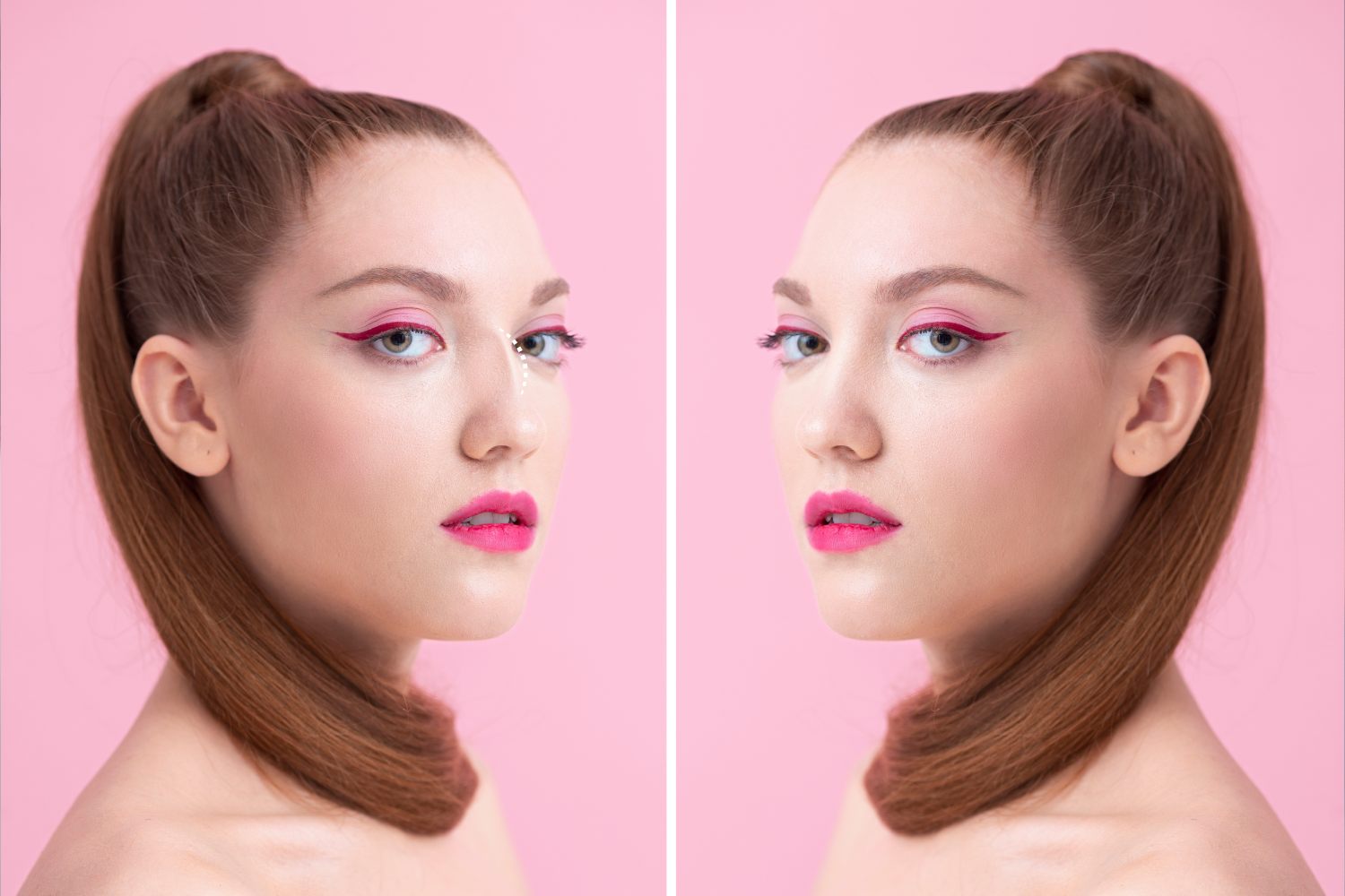 Rhinoplasty Before and After