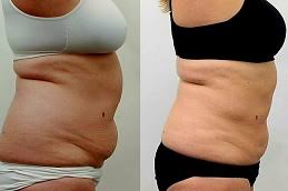 liposuction surgery in islamabad